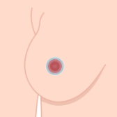 Peri-Areolar Lift