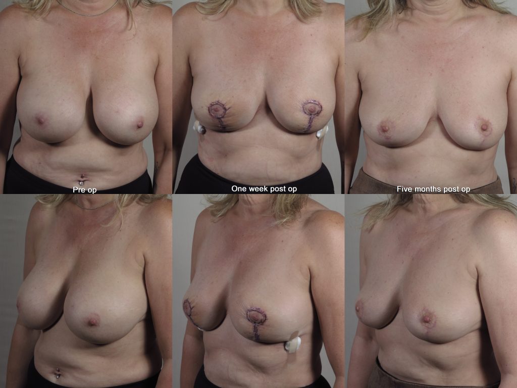Breast implant removal patient showing results of rapid recovery, 1 week post op and 5 months post op