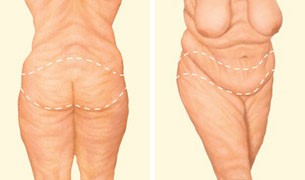 Diagram showing the back and front of a body receiving a body lift with dashed lines showing where the lifts are made.