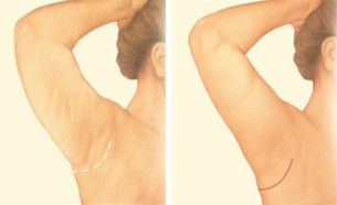 Image showing where the small incision near the arm pit for a short scar arm lift.