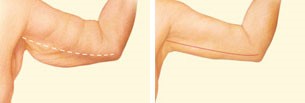Diagram showing where the incisions are made on a traditional arm lift.
