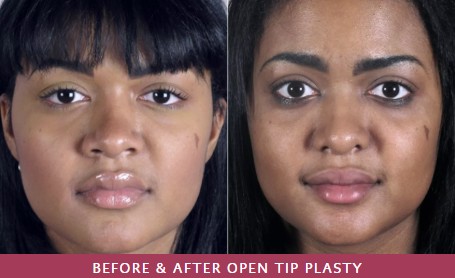 Before and after image showing the results of a tip plasty from Dr. Parker