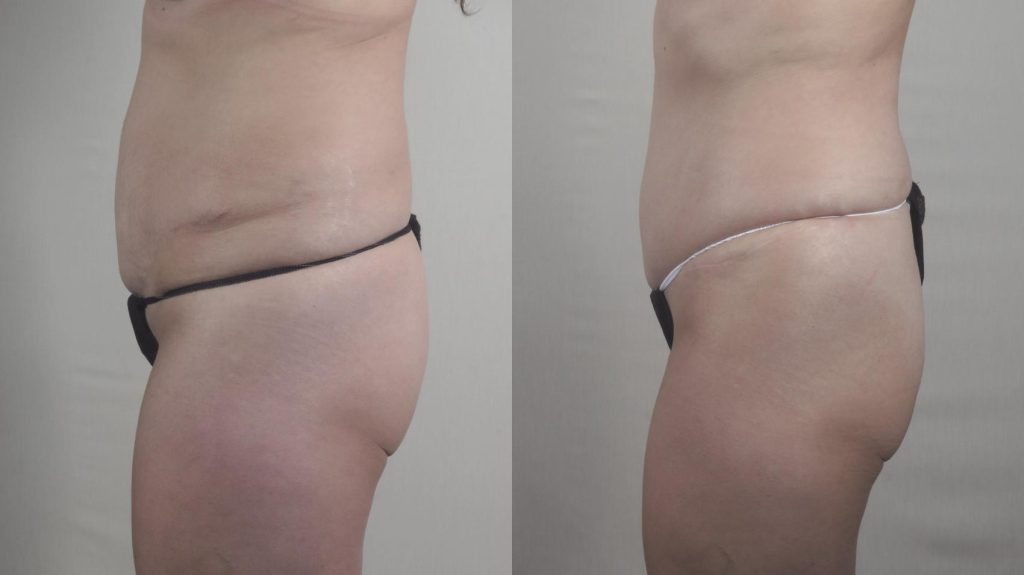 left side shows before image of a revision tummy tuck case and the right side shows the results of a revision tummy tuck with SAFE lipo from Dr. Parker
