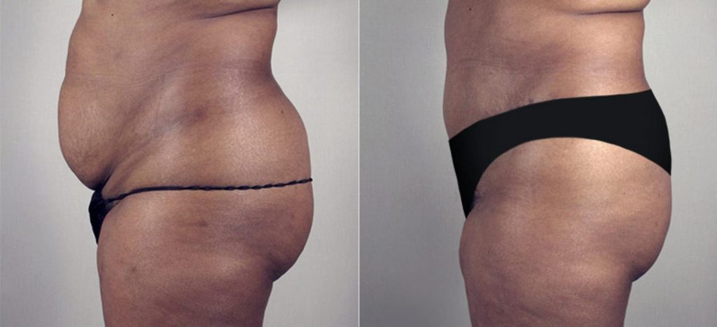 Side view showing the before image on the left and after results on the right for a patient who received a tummy tuck and liposuction procedure.