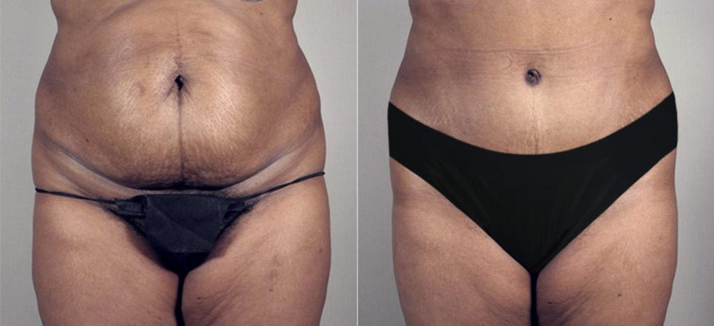 Front view showing the before image on the left and after results on the right for a patient who received a tummy tuck and liposuction procedure.