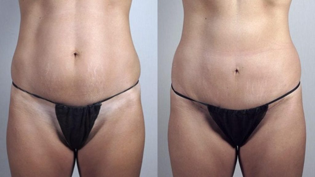 Left side image shows before mini tummy tuck and right side shows after  results