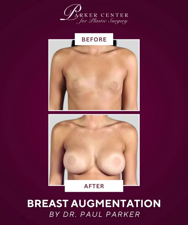 This 20-year-old patient came to Dr. Parker hoping to enhance her breast shape and size. She was an A cup and wanted a full C—but also had a condition called tuberous breasts that needed correction.

Dr. Parker customized a surgical plan using 500cc saline implants (as recommended by her rheumatologist), released the constricted tissue, and performed a lift on the left side for better symmetry.

She’s now loving her results—and feeling more confident than ever! 💗

☎️ (201) 967-1212
🗺 122 E Ridgewood Ave, Paramus, NJ 07652
📍 Parker Center for Plastic Surgery

This is an actual patient of our practice. Photos released with consent. Please do not use or distribute without permission
⁣

#paramus #paramusmall #paramusnj #bergencountynj  #breastlift #plasticsurgery #cosmeticsurgery #mastopexy #breastliftwithimplants #breastliftjourney breastliftresults #BergenCounty #BergenCountyNJ #ParamusNJ #EnglewoodCliffs #NewJerseyPlasticSurgery #NJPlasticSurgeon 
#BreastAugmentation #TuberousBreastCorrection #SalineImplants #BeforeAndAfter #ConfidenceBoost #DrParker #ParkerCenter