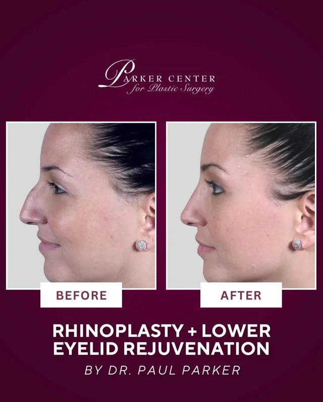 Natural, refreshed, and confident — without a visible scar ✨

This 25-year-old patient came to Dr. Parker after being referred by several patients. She wanted to refine the bump on her nose, lift a drooping nasal tip (especially when smiling), and rejuvenate her under-eye area.

Dr. Parker performed a closed rhinoplasty — meaning no visible external scars — to reshape her nose, remove the hump, and subtly elevate the tip for a more harmonious profile. 

He also corrected her lower eyelid puffiness with a scarless transconjunctival blepharoplasty, repositioning herniated fat to smooth the transition between her eyes and cheeks.

Her recovery? Virtually painless with minimal swelling or bruising — and her results speak for themselves. A more confident, refreshed version of herself.

Thinking about rhinoplasty? Schedule your consultation with Dr. Paul Parker in Paramus today and take the first step toward a nose that fits you. ✨💕

Book Today!✨
______________________
☎️ (201) 967-1212
🗺 122 E Ridgewood Ave, Paramus, NJ 07652
📍 Parker Center for Plastic Surgery is located in Paramus, New Jersey, conveniently located 40 minutes from New York City.

This is an actual patient of our practice. Photos released with consent. Please do not use or distribute without permission.

#ParamusNJ #BergenCounty #NorthJersey #Rhinoplasty #RhinoplastyExpert #RhinoplastySpecialist #DrPaulParker #NYC #Rhino #NoseJob #PlasticSurgeon #BergenCountyMoms #NJPlasticSurgeon #njnosejob #RhinoplastyBeforeAndAfter #RhinoplastyJourney