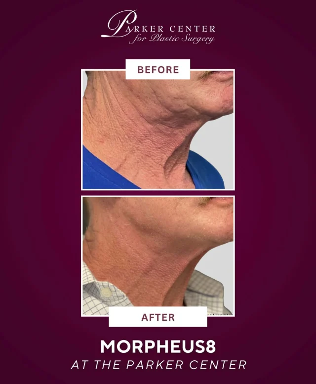 Jawline transformed. 💥

This patient saw smoother, firmer skin and noticeable tightening after Morpheus8 at The Parker Center.

Morpheus8 combines microneedling with radiofrequency to stimulate collagen production, remodel skin, and improve tone and texture—especially in areas like the neck, jawline, and lower face.

✨ Improves skin laxity and texture
✨ Boosts collagen + tightens contours
✨ Minimal downtime, powerful results

Curious if Morpheus8 is right for you?
📍 Book a consultation at The Parker Center today!

⁠☎️ (201) 967-1212
🗺 122 E Ridgewood Ave, Paramus, NJ 07652

#Morpheus8 #SkinTransformation #jawlinecontouring #Paramusnj #bergancounty #bergancountymoms #skintightening #SkinRejuvenation #newjerseymedspa #northjerseymedspa