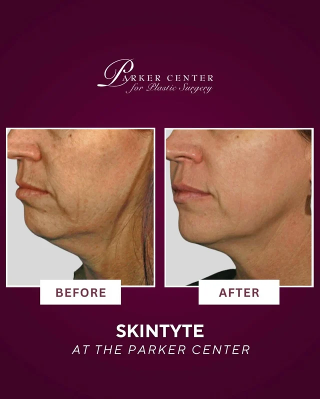 Say hello to a firmer, tighter jawline! ✨

This incredible before-and-after shows the power of Skintyte at The Parker Center.

By stimulating collagen deep within the skin, Skintyte improves laxity, smooths fine lines, and restores a more youthful contour — without surgery!

Ready to turn back the clock and feel like your best self?👇 Drop your questions in the comments—we’re here to help!

⁠☎️ (201) 967-1212
🗺 122 E Ridgewood Ave, Paramus, NJ 07652

#bergencountysalon #paramus #bergencountynj #bergencountymedspa #skintightening #skinlaxity #nonsurgical #necklift #paramus #paramusnj #njmedspa #skintyte #jawlinecontouring #bergencountymoms