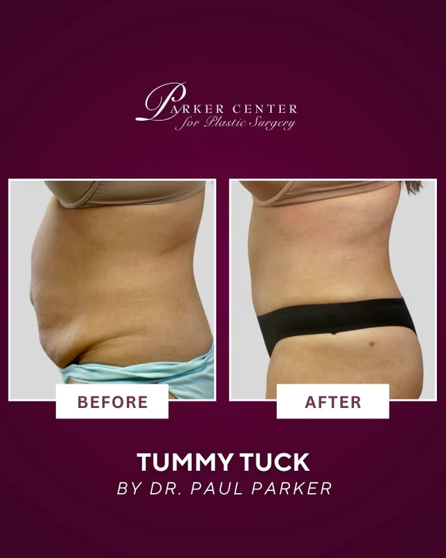✨ 5 months post-tummy tuck and Karen is radiating confidence! ✨

Her journey with Dr. Paul Parker and our team has been nothing short of transformative — from her first consultation to full recovery, she trusted the process and it shows.

Today, she’s moving, dressing, and living with a new sense of self-assurance — and we couldn’t be happier for her! 💃

💖 Ready to start your own transformation?
We’re here when you are.

📞 (201) 967-1212
📍 122 E Ridgewood Ave, Paramus, NJ 07652

#TummyTuckTransformation #ParkerCenterResults #ConfidenceRestored #RealPatientStory #PlasticSurgeryJourney #BeforeAndAfter #TummyTuckSuccess #paramus #bergencounty #bergencountymoms #tummytuck