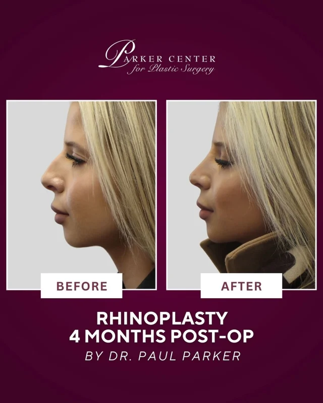 Four months post-rhinoplasty and she is living in her glow. ✨

Petra’s profile is refined, balanced, and beautifully hers. Confidence like this is exactly why patients trust Dr. Parker for natural, personalized results that honor your features rather than change who you are.

Considering rhinoplasty and want clarity on what is possible for you? Comment RHINOPLASTY and we will send you details. 💬👇

Book your consultation today! 

☎️ (201) 967-1212
🗺 122 E Ridgewood Ave, Paramus, NJ 07652
📍 Near NYC in Paramus, NJ

This is an actual patient of our practice. Photos released with consent. Please do not use or distribute without permission.

#ParamusNJ #BergenCounty #NorthJersey #Rhinoplasty #RhinoplastyExpert #DrPaulParker #NoseJob #NJPlasticSurgeon #RhinoplastyBeforeAndAfter #NaturalRhinoplasty #ProfilePerfection #BergenCountyMoms #NYCBeauty #RhinoplastyJourney #ParkerCenterResults #rhinopastyNJ #nosejob