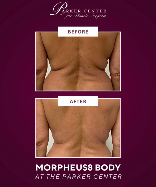A smoother, tighter contour — without surgery ✨

This patient wanted firmer skin and improved definition through the mid-back and flank area. With Morpheus8 Body, we were able to:

✅ Tighten laxity
✅ Improve skin texture
✅ Enhance natural contour

Morpheus8 uses radiofrequency microneedling to stimulate deep collagen and remodel tissue — ideal when skin needs tightening, not removal.

Considering skin tightening or body refinement?
We’re here to guide you toward the right solution 🤍

☎️ (201) 967-1212
🗺 122 E Ridgewood Ave, Paramus, NJ 07652
📍 Near NYC in Paramus, NJ

#Morpheus8Body #Morpheus8Results #RadiofrequencyMicroneedling #RFmicroneedling #BodySculptingTreatment #NonSurgicalSkinTightening #SkinTighteningTreatment #LooseSkinSolution #StretchMarkTreatment #CollagenStimulation #BodyRejuvenation #BodyConfidenceJourney #TightenAndTone #SmoothSkinGoals #YouthfulSkin #AgingGracefully #NJMedSpa #ParamusNJ #BergenCounty #NorthJersey #ParkerCenter #bergencountymoms