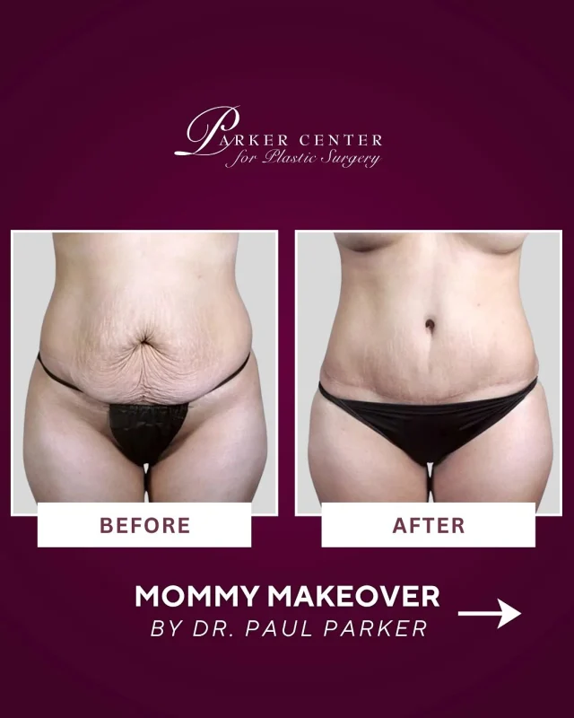 Strong. Confident. Completely renewed. ✨

At 40, our patient wanted lifted, youthful breasts and a smoother, more defined abdomen and waistline after having three children. Her Mommy Makeover restored balance, shape, and confidence in a way that feels natural and beautifully hers.

Motherhood changed her body — this transformation helped her rediscover it.

Ready to feel at home in your skin again?
Comment “MOMMY MAKEOVER” and we’ll send pricing, recovery info, and consultation availability. 💬👇

☎️ (201) 967-1212
🗺 122 E Ridgewood Ave, Paramus, NJ 07652
📍 Near NYC in Paramus, NJ

This is an actual patient of our practice. Photos released with consent.

#MommyMakeover #ConfidenceRestored #BodyRejuvenation #BreastLift #TummyTuck #Liposuction #ParkerCenter #ParamusNJ #BergenCountyMoms #NorthJersey #postbabybody #NaturalResults #PlasticSurgeryJourney #StrongerThanEver