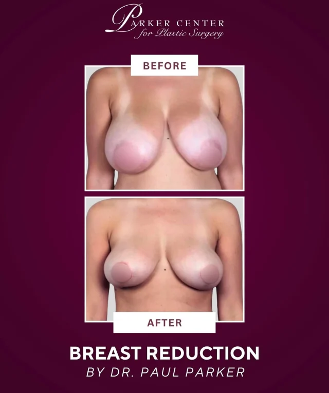 Life-changing comfort and confidence. 🤍

This 27-year-old patient came to Dr. Parker seeking relief from the physical and emotional strain of overly heavy breasts. After years of discomfort, her primary care doctor referred her to us for a breast reduction and lift.

Dr. Parker performed a vertical breast reduction and lift, removing excess tissue to create a lighter, balanced, beautifully natural C-cup result. She healed quickly and is thrilled with her new shape, improved comfort, and minimal scarring.

Breast reduction is more than a cosmetic procedure. It can relieve back and neck pain, improve posture, expand clothing options, and restore daily comfort.

If you are ready to feel light, confident, and comfortable in your body again, we would love to help you explore your options.

☎️ (201) 967-1212
📍 Paramus, NJ
Performed by Dr. Paul Parker

This is an actual patient of our practice. Photos released with consent.

#BreastReduction #BreastLift #VerticalBreastReduction #NaturalResults #ParkerCenter #ParamusNJ #BergenCounty #NJPlasticSurgeon #BreastReductionJourney #BreastReductionBeforeAndAfter #ConfidenceRestored #BackPainRelief #BreastLiftResults #MomLifeComfort #FeelYourBest #bergencountymoms #njmoms