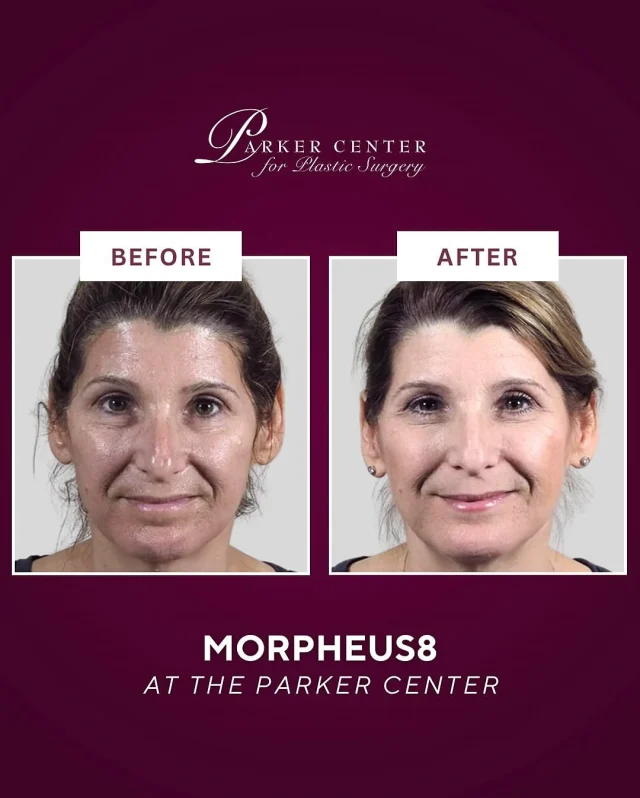 ✨ Just 2 Months After Morpheus8 ✨
This stunning transformation is already turning heads—and the best part? Results will continue to improve over time.

Here’s what’s changed so far:
✅ Smoother, firmer skin
✅ A more lifted jawline and cheeks
✅ Brighter, more even tone
✅ Faded brown spots

Morpheus8 works deep beneath the surface to stimulate collagen and tighten skin—naturally and gradually.

Considering it?
Drop your questions below or DM us. We’re here to help you feel confident in your skin.

⁠☎️ (201) 967-1212
🗺 122 E Ridgewood Ave, Paramus, NJ 07652

Actual patient. Photos shared with consent.

#Morpheus8 #SkinTightening #2MonthResults #ParamusNJ #NorthJerseyMedSpa #BergenCountyMoms #GlowUp #SkinGoals #NaturalRejuvenation