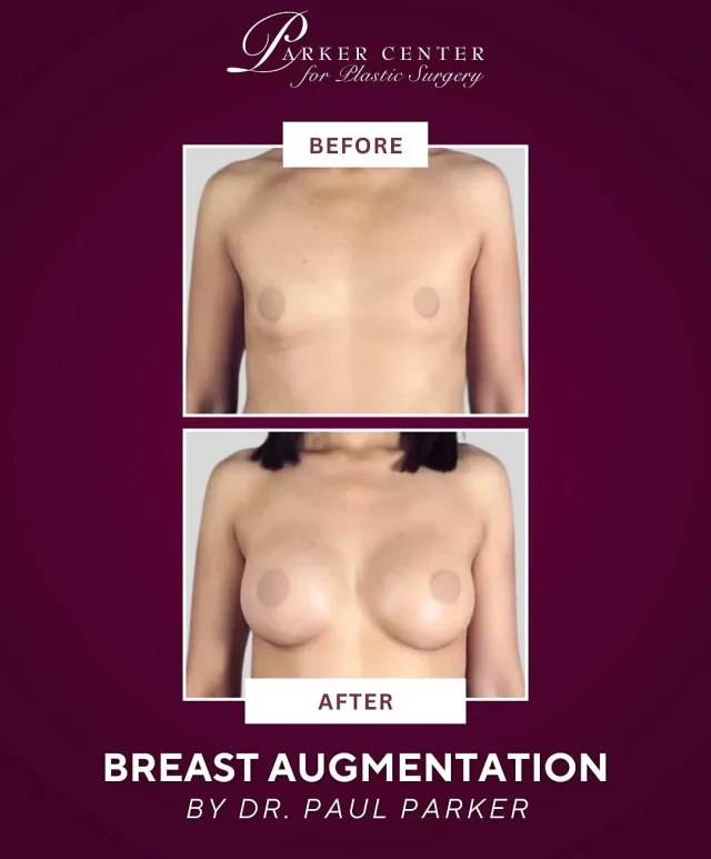 She wanted fuller, more proportionate breasts—and Dr. Parker delivered.✨

This 35-year-old patient came to us wanting to enhance her A cup to a natural-looking C cup. With 375cc silicone implants, she now feels confident, balanced, and beautifully in proportion. Smooth recovery. Minimal discomfort. Gorgeous results.

Thinking about breast augmentation? Drop your questions below or DM us to schedule a consultation with Dr. Parker.

☎️ (201) 967-1212
🗺 122 E Ridgewood Ave, Paramus, NJ 07652
📍 Parker Center for Plastic Surgery

This is an actual patient of our practice. Photos released with consent. Please do not use or distribute without permission
⁣

#paramus #paramusmall #paramusnj #bergencountynj  #breastlift #plasticsurgery #cosmeticsurgery #breastaugmentation #mommymakeover #bodycontouring #boobjob #mastopexy #breastliftwithimplants #breastliftjourney #breastliftsurgery #breastliftresults #BergenCounty #BergenCountyNJ #ParamusNJ #EnglewoodCliffs #NewJerseyPlasticSurgery #NJPlasticSurgeon #BergenCountyBeauty #northjerseyaesthetics