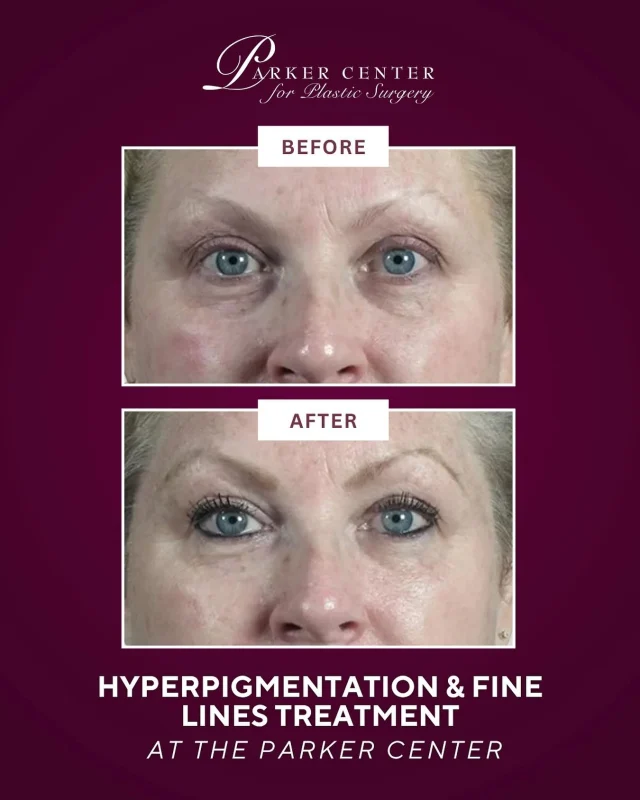 This glow speaks for itself. ✨

Our patient came to us wanting a smoother, brighter, more even complexion. After a customized Halo treatment with Angela, FNP-C, her skin now looks luminous, refined, and refreshed.

Halo’s dual-wavelength technology works deep and on the surface to:
✅ Fade hyperpigmentation and discoloration
✅ Smooth fine lines and improve texture
✅ Restore a youthful, healthy radiance

If you are tired of filters and want results you can see and feel, do not wait.
Drop “HALO” below to get pricing, recovery details, and priority access to our next openings. 💬👇

Spots fill fast, and Halo is in peak-season demand. Start now, glow by spring.

☎️ (201) 967-1212
🗺 122 E Ridgewood Ave, Paramus, NJ 07652
📍 Near NYC in Paramus, NJ

This is an actual patient of our practice. Photos released with consent. Please do not use or distribute without permission.

#HaloLaser #BBLForeverYoung #ParkerCenterSkin #ParamusNJ #BergenCounty #NorthJerseySkin #LaserResurfacing #HaloBeforeAndAfter #SkinRejuvenation #LuminousSkin #AgeGracefully #SkinConfidence #NaturalResults #BergenCountyMoms #NYCBeauty #njmedspa #northjersey #bergencountymoms