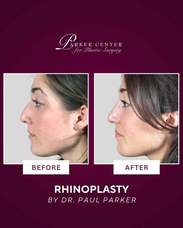 ✨Subtle, Natural, and Confident✨

This beautiful 21-year-old patient came to Dr. Parker hoping to smooth the dorsal hump that had developed on her nose—while keeping her nasal tip untouched. Using a closed rhinoplasty technique, Dr. Parker removed the bony-cartilaginous hump and refined the nose with precision infractures.

The result? A smooth, natural-looking profile that fits her face—without changing who she is. 💫
She was thrilled by how quick and painless her recovery was—and even more excited about her results!

Thinking about rhinoplasty? Schedule your consultation with Dr. Paul Parker in Paramus today and take the first step toward a nose that fits you. ✨💕

Book Today!✨
______________________
☎️ (201) 967-1212
🗺 122 E Ridgewood Ave, Paramus, NJ 07652
📍 Parker Center for Plastic Surgery is located in Paramus, New Jersey, conveniently located 40 minutes from New York City.

This is an actual patient of our practice. Photos released with consent. Please do not use or distribute without permission.

#ParamusNJ #BergenCounty #NorthJersey #Rhinoplasty #RhinoplastyExpert #RhinoplastySpecialist #DrPaulParker #NYC #Rhino #NoseJob #PlasticSurgeon #BergenCountyMoms #NJPlasticSurgeon #njnosejob #RhinoplastyBeforeAndAfter #rhinoplastyjourney