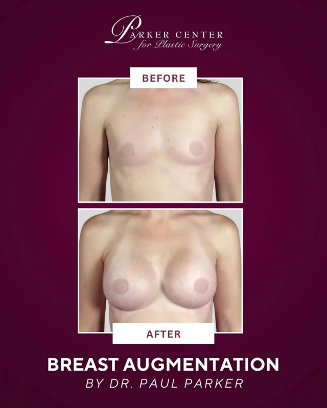 Breast Augmentation✨

After having two children and breastfeeding, this 33-year-old mama wanted her confidence—and her curves—back. 💗

At 5’1” and 98 lbs, she wore an A cup and chose 325cc silicone implants after personalized sizing sessions with Dr. Parker. Implants were placed using a dual plane technique through a small incision under the breast.

Her recovery was smooth, and she’s thrilled with her beautiful, natural-looking results! ✨

💬 Comment “BREAST AUG” to see more before & afters + learn about the Parker Center experience.

☎️ (201) 967-1212
🗺 122 E Ridgewood Ave, Paramus, NJ 07652
📍 Parker Center for Plastic Surgery

This is an actual patient of our practice. Photos released with consent. Please do not use or distribute without permission
⁣

#paramus #paramusmall #paramusnj #bergencountynj  #breastlift #plasticsurgery #cosmeticsurgery #breastaugmentation #mommymakeover #bodycontouring #boobjob #mastopexy #breastliftwithimplants #breastliftjourney #breastliftsurgery #breastliftresults #BergenCounty #BergenCountyNJ #ParamusNJ #EnglewoodCliffs #NewJerseyPlasticSurgery #NJPlasticSurgeon #BergenCountyBeauty #northjerseyaesthetics