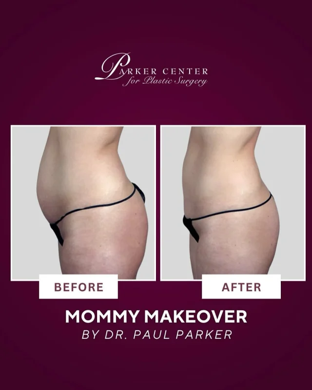 Mommy Makeover✨

S W I P E 👈 L E F T

After having kids, this 32-year-old nurse was ready to feel like herself again. Referred by a co-worker, she came to Dr. Parker wanting to restore breast fullness and address stubborn belly fat.

She underwent a customized Mommy Makeover—mini lipoabdominoplasty and breast augmentation with 275cc silicone implants. Her recovery was smooth, and she loved how her new figure made clothes fit better! ✨

Swipe left to see her transformation — and her second enhancement years later, when she returned to go bigger with 450cc implants (and had zero pain, bruising, or downtime 🙌).

💬 Comment “MOMMYMAKEOVER” to get before & afters + details on your options at the Parker Center!

Schedule Today!✨
______________________
☎️ (201) 967-1212
🗺 122 E Ridgewood Ave, Paramus, NJ 07652
📍 Parker Center for Plastic Surgery is located in Paramus, New Jersey, conveniently located 40 minutes from New York City.

This is an actual patient of our practice. Photos released with consent. Please do not use or distribute without permission.

#TummyTuck #ParkerTummyTuck #BeforeAndAfter #Lipoabdominoplasty #PostBabyBody #MommyMakeover #BodyConfidence #PlasticSurgeryJourney #ParkerCenter #paramus #paramusnj #bergencounty #bergencountymoms #NaturalResults #AbdominalRejuvenation #BreastAugmentation #Lipoabdominoplasty