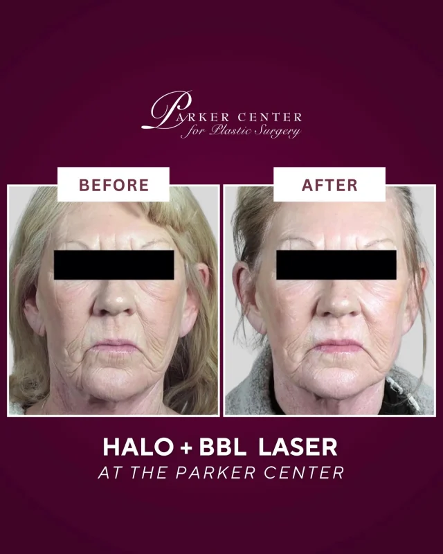 ✨ Smooth, Firm, Radiant Skin with Halo Laser ✨

RESULTS AFTER ONE TREATMENT 

This patient’s top concern was facial wrinkles. Angela treated her face + neck with the Halo™ laser, a non-surgical skin rejuvenation treatment that stimulates collagen, tightens skin, and improves tone + texture. 🌟 

With no downtime and natural-looking results, she’s already excited for her next session to further enhance her glow!

➡️ Considering Halo laser skin resurfacing in Paramus, NJ? Call our office or DM us today to book your consultation with our expert aesthetic team.

#HaloLaser #LaserSkinResurfacing #SkinTightening #FacialRejuvenation #ParamusMedSpa #BergenCountyAesthetics #NJMedSpa #bergencounty #bergencountymoms #paramus