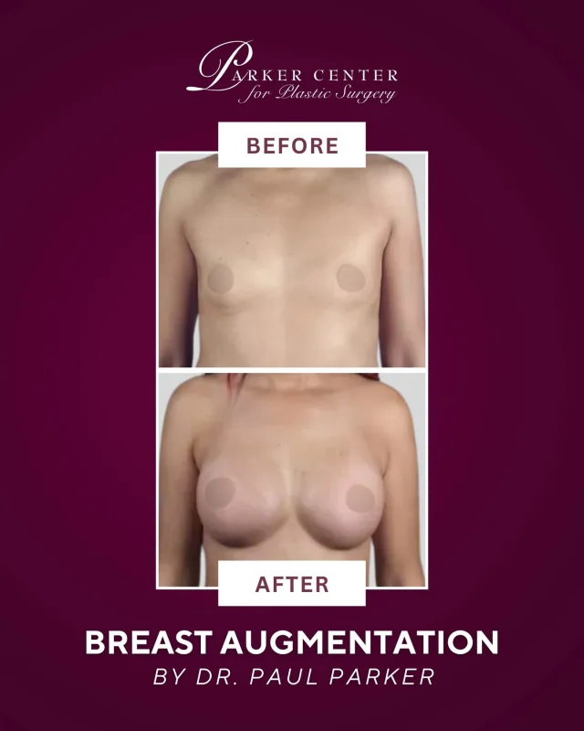 Breast Augmentation✨ 

This breast augmentation result highlights natural shape, balanced proportions, and a look that feels beautifully you. Thoughtful planning, precise technique, and individualized care make all the difference.

Performed by Dr. Paul Parker at the Parker Center for Plastic Surgery, where results are never one-size-fits-all — they’re designed around your body and your goals.

✨ Ready to explore your options?
Schedule a personalized consultation and take the next step toward feeling confident in your own skin.

#ParamusNJ #BergenCountyNJ #NorthJersey #NJPlasticSurgery #BergenCountyLiving #BreastAugmentationNJ #ParamusPlasticSurgery #NJCosmeticSurgery #ParkerCenter