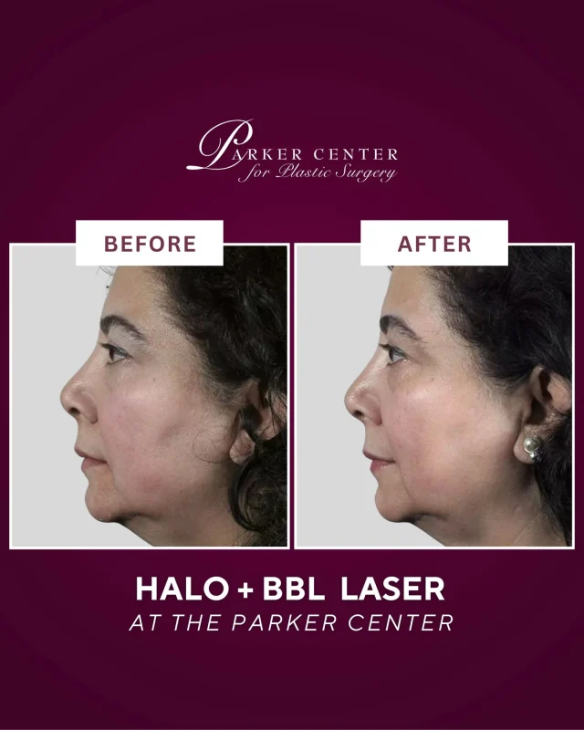 A smoother, brighter, more youthful complexion ✨

This patient came to The Parker Center to address sun spots, fine lines, wrinkles, and uneven texture. After Halo + BBL laser treatment, her pigmentation lightened significantly (with some spots disappearing completely), her skin texture improved, and fine lines softened — with results continuing to improve in the weeks following treatment.

If you are looking to refresh, rejuvenate, and truly love your skin again, our team is here to guide you.

📍 Parker Center for Plastic Surgery | Paramus, NJ
📞 Call today to schedule your consultation

#HaloLaser #BBLLaser #LaserResurfacing #SkinRejuvenation #SunDamageRepair #FineLinesAndWrinkles #GlowingSkin #ParamusNJ #BergenCountyNJ #NorthJerseyAesthetics #NewJerseySkin #BergenCountyBeauty