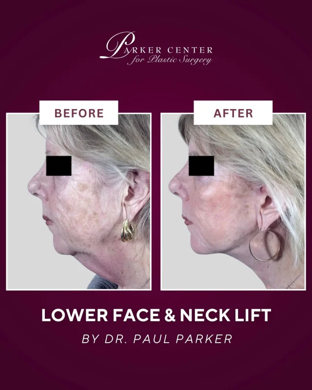 A beautiful, natural transformation ✨

This 66-year-old patient came to Dr. Parker concerned about laxity in her lower face and neck. Dr. Parker performed a lower face and neck lift, removing excess fat under the chin while tightening the underlying muscles and skin to create a smoother, more youthful contour and long-lasting results.

She healed beautifully — and was glowing in time for her daughter’s wedding just 3 months after surgery 💫

Thinking about facial rejuvenation? Our experienced team will guide you, answer your questions, and help you feel like your best self.

📍 Parker Center for Plastic Surgery
📞 Call to schedule your consultation today

#FaceliftResults #LowerFaceLift #NeckLiftSurgery #FacialRejuvenation #PlasticSurgeryBeforeAndAfter #AgingGracefully #NaturalLookingResults #BoardCertifiedPlasticSurgeon #NewJerseyPlasticSurgery #BergenCountyPlasticSurgery #ParamusNJ #NewJerseyAesthetics #NorthJerseyMoms