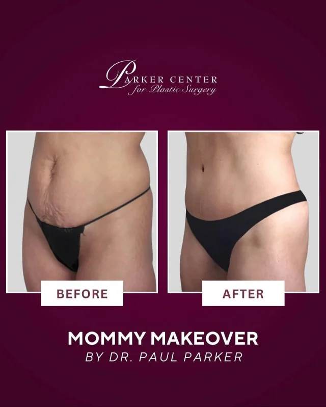This beautiful mommy makeover transformation is a reminder that you deserve to feel confident, comfortable, and completely yourself again.

At our private surgical center in Bergen County, we help mothers reclaim their bodies with artistry, precision, and care—no shortcuts, no one-size-fits-all approach.

Because this isn’t about vanity—it’s about you feeling whole again.

Have questions? Drop them below or send us a DM—we’re here to walk you through every step.

☎️ (201) 967-1212
🗺 122 E Ridgewood Ave, Paramus, NJ 07652
📍 Parker Center for Plastic Surgery 

This is an actual patient of our practice. Photos released with consent. Please do not use or distribute without permission

#MommyMakeover #BergenCountyMoms #BergenCountyPlasticSurgery #NJMommyMakeover #ParamusNJ #NorthJerseyMoms #BodyAfterBaby #PostpartumBodyGoals #ConfidenceRestored #NJPlasticsurgery #MomTransformation #MommyGlowUp #BergenCountyBeauty #NewJerseyMoms #luxuryplasticsurgery
