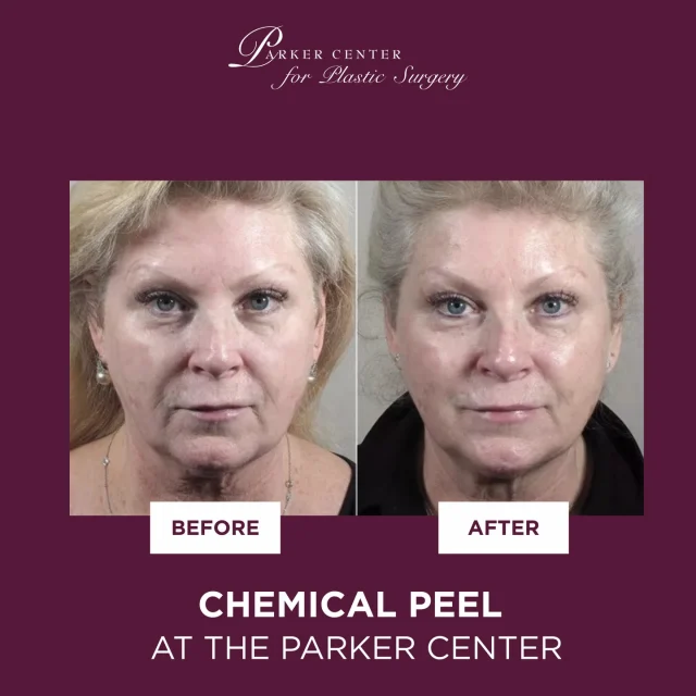 Glowing skin, just 9 days later ✨

This patient received a VI Peel, and her “after” photos were taken 9 days post-treatment — the results speak for themselves.

Chemical peels like the VI Peel help improve skin tone and texture while reducing the appearance of fine lines, acne, and discoloration, revealing a smoother, brighter complexion underneath.

Ready to refresh your skin? We’re here when you are. 💫

#VIPeel #ChemicalPeelResults #SkinRenewal #MedicalAesthetics #GlowingSkin #ParkerCenter