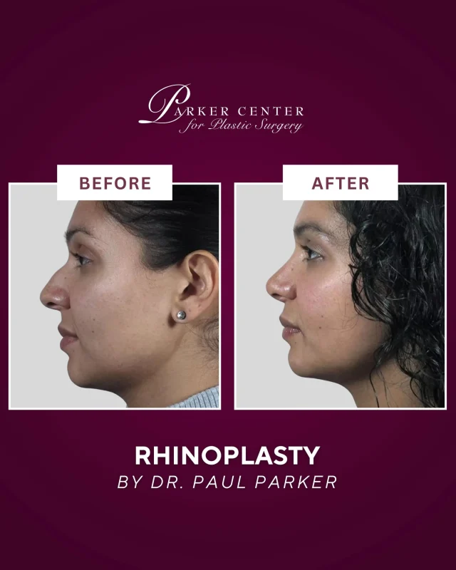 ✨ Rhinoplasty with natural, balanced results ✨

This 27-year-old patient came to Dr. Parker hoping to correct a crooked nose, reduce a dorsal hump, refine a bulbous tip, and create a more proportionate nostril shape — without looking “overdone.”

Using an open rhinoplasty approach, Dr. Parker was able to straighten the nose, smooth the profile, refine the tip, and narrow the nasal bridge for a result that looks soft, natural, and beautifully in harmony with her features.

The best part? Minimal bruising, no pain, and a confidence boost that speaks for itself.

Ready to explore rhinoplasty with results that still look like you?
Click the link in bio to schedule a consultation.

#Rhinoplasty #NJPlasticSurgery #ParamusNJ #BergenCountyNJ #NoseJobNJ