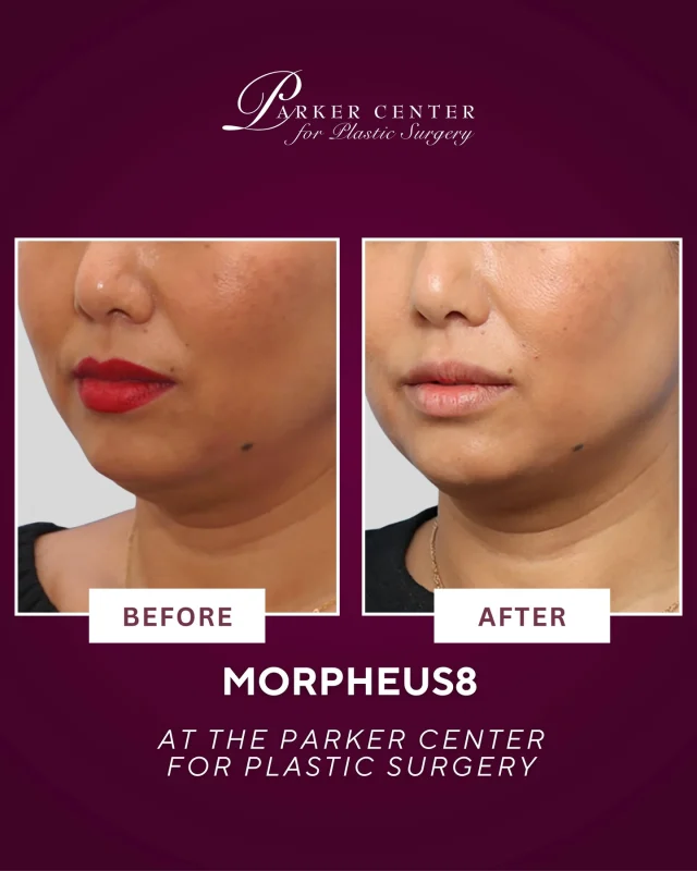Snatched, smoothed, tightened — without surgery ✨

This is exactly why we love Morpheus8.
By combining microneedling + radiofrequency, Morpheus8 helps tighten laxity, refine texture, and improve the appearance of fullness under the chin/jawline for a more sculpted look over time.

Results like this don’t happen overnight — they’re built through collagen + consistency, and the glow only gets better as the weeks go on.

Ready for a more defined jawline + firmer skin?
Click the link in bio to request your consultation.

#Morpheus8 #RFmicroneedling #SkinTightening #JawlineContour #ParkerCenter