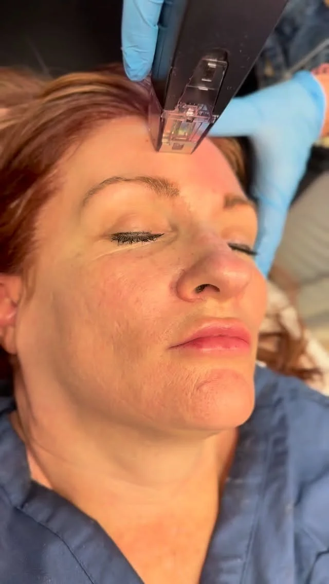 Tighter skin. Smoother texture. Real results. ✨

Morpheus8 is one of our go-to treatments for patients who want noticeable skin tightening without surgery.

From boosting collagen and refining texture to improving acne scars and treating both the face and body—this treatment does it all with minimal downtime and long-lasting results.

If you’re ready for firmer, more youthful-looking skin that improves over time, Morpheus8 might be your answer.

📅 Book a consultation and let’s create a plan tailored to you.
☎️ (201) 967-1212
🗺 122 E Ridgewood Ave, Paramus, NJ 07652
📍 Parker Center for Plastic Surgery is located in Paramus, New Jersey, conveniently located 40 minutes from New York City.

#Morpheus8 #SkinTightening #RFMicroneedling #CollagenBoost #plasticsurgery #MedicalAesthetics #medspa #parkercenter #bergencounty #paramusnj