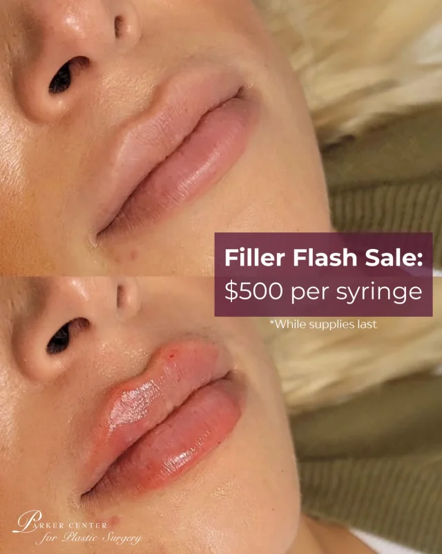 Filler Flash Sale ✨

$500 per syringe — while supplies last.

Now’s your chance to lock in special pricing on one of our most-loved treatments. Buy now, use later, and treat yourself (or plan ahead for your next refresh 😉).

This offer won’t last — secure your syringe before the sale ends January 31, 2026.

📞 Call us for details or to reserve yours today.
☎️ (201) 967-1212
🗺 122 E Ridgewood Ave, Paramus, NJ 07652
📍 Parker Center for Plastic Surgery is located in Paramus, New Jersey, conveniently located 40 minutes from New York City.

#filler #lipfillerbeforeandafter #medspa #bergencountynj #parkercenter