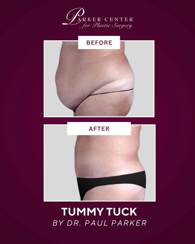 This 48-year-old patient came to Dr. Parker with one goal: to finally get rid of the stubborn “tire” around her waist that wouldn’t budge — especially after a serious car accident and years of back pain made exercise nearly impossible.

After reviewing her goals and medical history (and coordinating with her spine surgeon), Dr. Parker performed a lipoabdominoplasty combined with SAFE liposuction of the hips to restore a smoother, more contoured silhouette.

✨ 10 pounds of abdominal tissue removed
✨ 950cc of fat removed from each hip
✨ A transformation that looks natural — and feels life-changing

 Ready to explore your options?
Click the link in bio to schedule a consultation.

#TummyTuck #Abdominoplasty #BodyContour #NJPlasticSurgery #ParkerCenter
