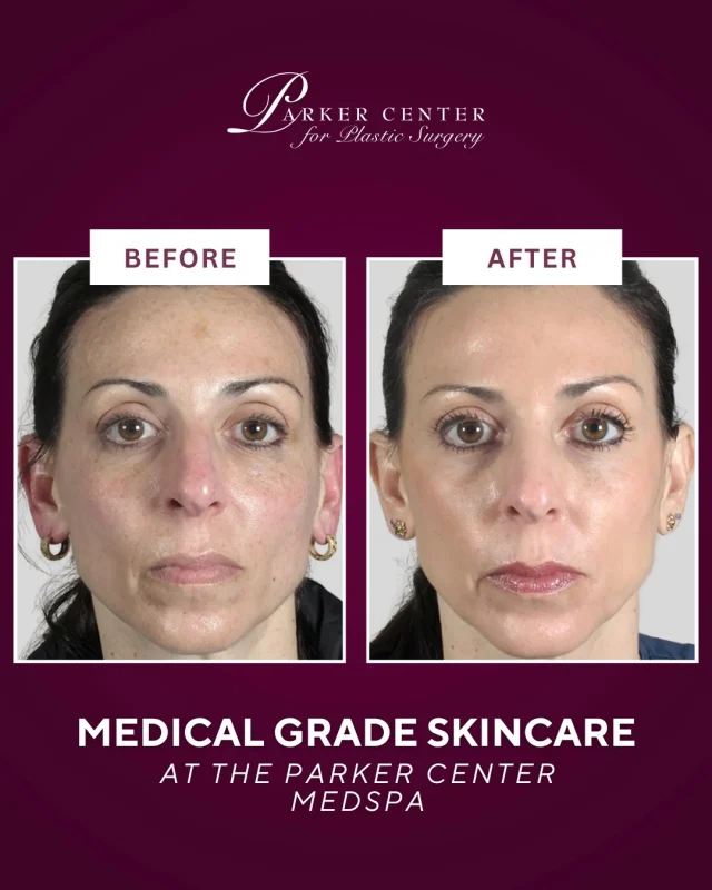 Real results. Real skin transformation. ✨

This patient followed a customized medical-grade skincare plan at Parker Center for Plastic Surgery MedSpa, and the difference speaks for itself — brighter tone, smoother texture, and healthier-looking skin without heavy makeup or filters.

Professional products + expert guidance = skin that actually changes.

If you’ve been investing in skincare but not seeing results, it may be time for a regimen designed for your skin, not the drugstore shelf.

✨ Book now and glow effortlessly.
______________________
☎️ (201) 967-1212
🗺 122 E Ridgewood Ave, Paramus, NJ 07652
📍 Parker Center for Plastic Surgery 

#ParkerCenterMedSpa #ParamusNJ #NewJerseyMedSpa #MedicalGradeSkincare #SkinRejuvenation