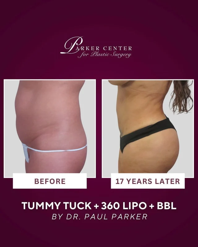 Parker Tummy Tuck + 360 + BBL ✨

This stunning 46-year-old patient is 17 years post-op after a Parker Tummy Tuck®, 360° liposuction, and fat transfer to the buttocks (BBL).

She was only seen once after surgery—and just recently returned to explore other procedures. At the time of surgery, she weighed 146 lbs and now maintains a healthy 135 lbs through clean eating and regular exercise.

✨ This is exactly what we love to see: long-lasting results made even better by a patient’s commitment to a healthy lifestyle.

Surgery sets the foundation—you bring it to life. 💪

📲 Curious what’s possible for you? Schedule your consultation with Dr. Parker and let’s create your transformation plan.

#ParkerTummyTuck #360Lipo #BBLResults #plasticsurgery #bergencounty newjersey paramus paramusnj bergencountymoms bbl tummytuck BodyContourGoals PlasticSurgeryJourney