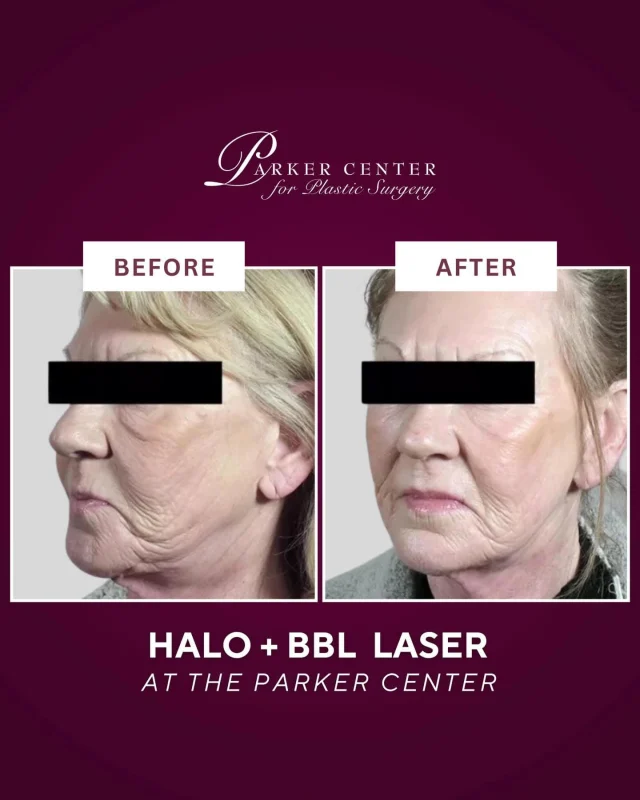 ✨ Smooth, Firm, Radiant Skin with Halo Laser ✨

RESULTS AFTER ONE TREATMENT 

This patient’s top concern was facial wrinkles. Angela treated her face + neck with the Halo™ laser, a non-surgical skin rejuvenation treatment that stimulates collagen, tightens skin, and improves tone + texture. 🌟 

With no downtime and natural-looking results, she’s already excited for her next session to further enhance her glow!

➡️ Considering Halo laser skin resurfacing in Paramus, NJ? Call our office or DM us today to book your consultation with our expert aesthetic team.

#HaloLaser #LaserSkinResurfacing #SkinTightening #FacialRejuvenation #ParamusMedSpa BergenCountyAesthetics NJMedSpa bergencounty bergencountymoms paramus