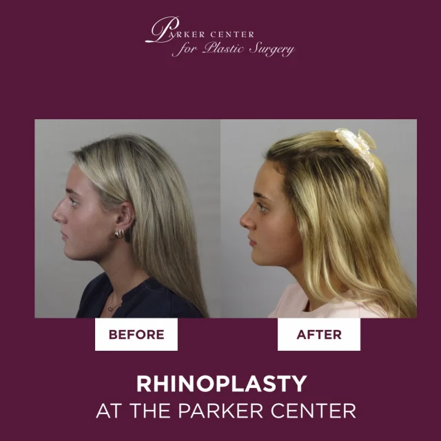 A subtle change can make a powerful difference.

This young patient came to Dr. Parker hoping to soften her nasal hump and refine the tip—while still looking completely like herself. 

Through a carefully planned open rhinoplasty, Dr. Parker focused on balance, proportion, and natural refinement to enhance her features without overcorrection.

The result? A beautifully natural profile, a smooth recovery, and a boost in confidence she feels every day. She now loves seeing herself from every angle—and that’s what thoughtful, patient-centered surgery is all about.

👉 Natural results. Expert care. Personalized outcomes.

Interested in a rhinoplasty? Book your consult today! ✨
☎️ (201) 967-1212
🗺 122 E Ridgewood Ave, Paramus, NJ 07652
📍 Parker Center for Plastic Surgery is located in Paramus, New Jersey, conveniently located 40 minutes from New York City.

#rhinoplastybeforeandafter #rhinoplasty #plasticsurgerybeforeandafter #bergencountynj