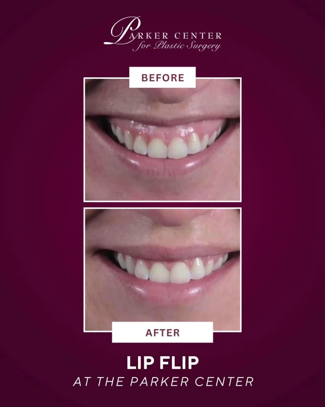 Subtle. Strategic. Stunning.

This is what a lip flip is meant to do 👄

✨ Relax the upper lip
✨ Reveal more of your natural smile
✨ Create the illusion of fuller lips — without adding volume

No filler. No overdone look.
Just a softer, more balanced smile.

If you love your lips but want them to show up a little more… this is your sign.

Schedule your consultation at Parker Center and let’s refine — not change — what’s already beautiful.

#bergencounty #paramus #lipflip #botox #gummysmile