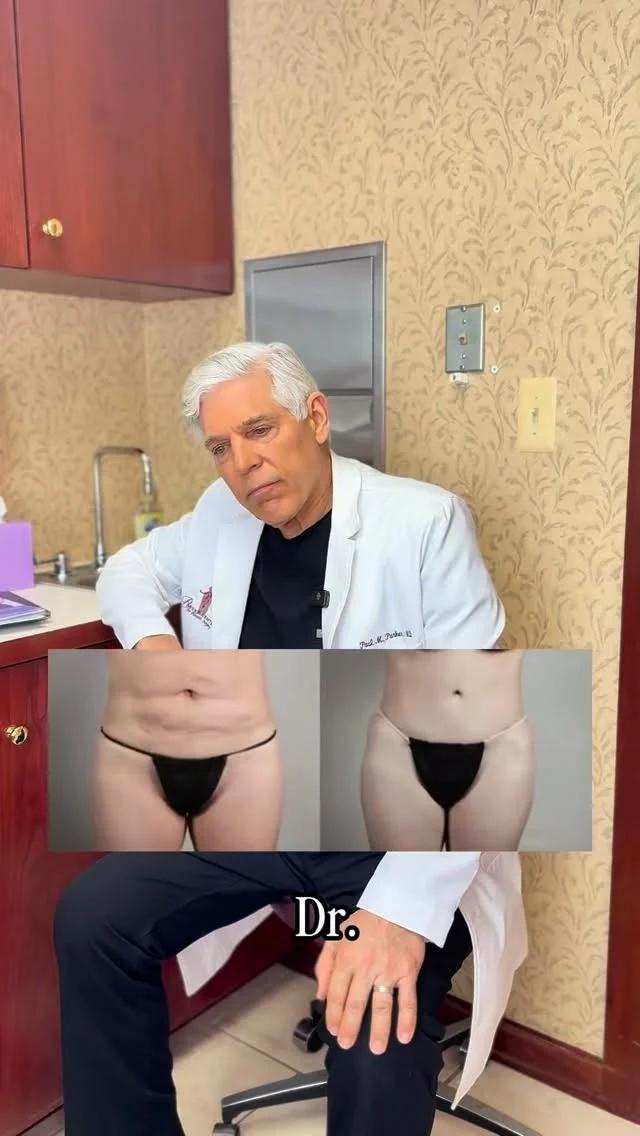 One surgery. One anesthesia. One recovery. 🤍

A Mommy Makeover isn’t just about combining procedures — it’s about simplifying the journey.

In this reel, Dr. Parker breaks down one of the biggest advantages of a mommy makeover: instead of scheduling separate surgeries for your breasts, tummy, and liposuction, everything is thoughtfully performed in a single operation.

That means:
✔️ One time under anesthesia
✔️ One surgical date to plan for
✔️ One recovery period
✔️ One transformation process

For many women, that efficiency makes the experience more manageable — physically, emotionally, and logistically.

If you’ve been considering restoring your pre-baby body (or simply feeling more like yourself again), this could be the streamlined approach you’ve been looking for.

Ready to explore your options? Schedule a consultation with Dr. Parker to see if a Mommy Makeover is right for you. ✨
☎️ (201) 967-1212
🗺 122 E Ridgewood Ave, Paramus, NJ 07652
📍 Parker Center for Plastic Surgery is located in Paramus, New Jersey, conveniently located 40 minutes from New York City.

#mommymakeovers #tummytuckbeforeandafter #lipo #plasticsurgery #paramusnj