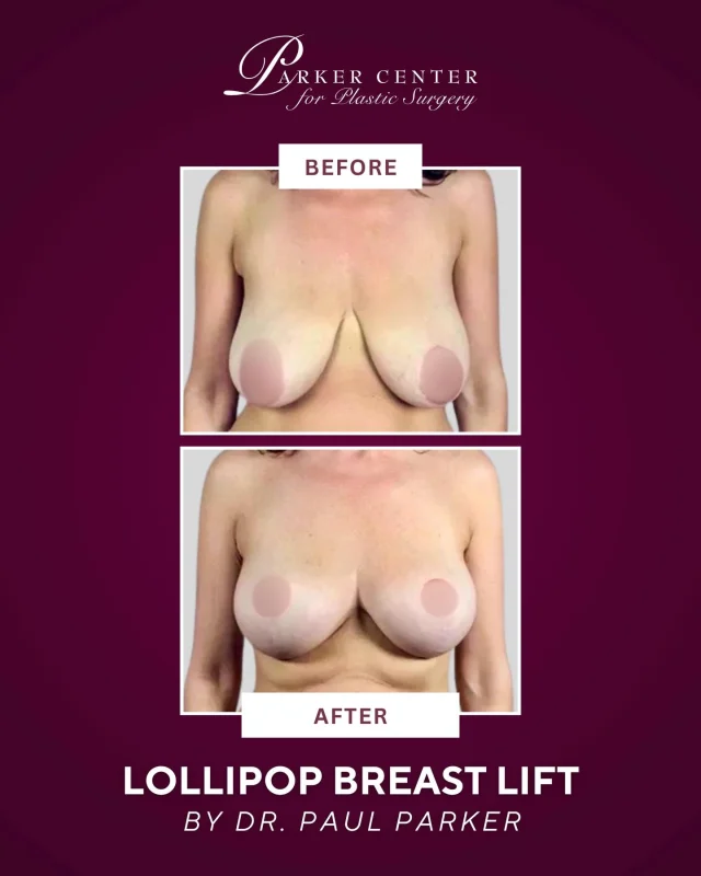 Lollipop Breast Lift 🍭✨

This 43-year-old patient came to Dr. Parker seeking correction of drooping, heavy breasts. At 5′5″ and 112 lbs, she wanted her natural D cup size uplifted and slightly reduced. Dr. Parker performed a vertical mastopexy (“lollipop lift”), carefully removing 90 grams on the left and 70 grams on the right.

✅ Quick recovery with minimal discomfort
✅ Noticeably more youthful, uplifted look
✅ Results shown 6 years later—proving the outcome is long-lasting

She couldn’t be happier with her natural, refreshed shape! 💜

📍 Parker Center for Plastic Surgery – Paramus, NJ
📲 Call us today to schedule your breast lift consultation.

#BreastLift #LollipopLift #Mastopexy #BreastSurgery #BreastLiftResults BeforeAndAfterSurgery PlasticSurgeryTransformation BoardCertifiedPlasticSurgeon ParkerCenter ParamusNJ BergenCountyNJ NorthJersey NJPlasticSurgery NYCtoNJ RidgewoodNJ HackensackNJ EnglewoodNJ FairLawnNJ HudsonCounty EssexCounty MorrisCounty