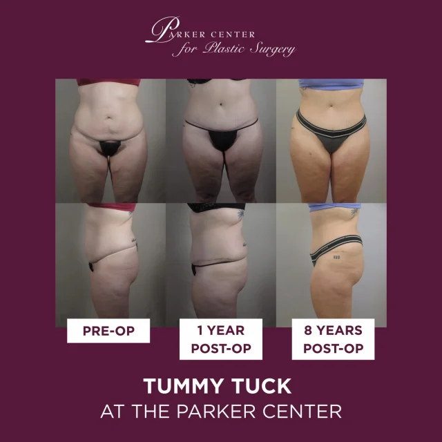 Eight years later… and still glowing. ✨

One of the most rewarding parts of what we do is seeing patients come back years after their surgery and witnessing how their results—and confidence—have stood the test of time.

This patient lost 90 pounds through diet and exercise and chose to undergo an abdominoplasty with Dr. Parker to complete her transformation. Her photos show her journey before surgery, one year after, and now eight years later.

Results like this are a reminder that surgery isn’t just about the immediate change—it’s about creating results that last and supporting patients through every stage of their journey.

To our amazing patients who trust us with these milestones in their lives… thank you. It truly means the world to see you thriving years later.❤️

If you’re considering a tummy tuck and wondering if it might be right for you, we’re here to help guide you through the process.

📩 Send us a message or schedule a consultation to learn more.
☎️ (201) 967-1212
🗺 122 E Ridgewood Ave, Paramus, NJ 07652
📍 Parker Center for Plastic Surgery is located in Paramus, New Jersey, conveniently located 40 minutes from New York City.

#beforeandafter #tummytuck #tummytuckbeforeandafter #plasticsurgerynj