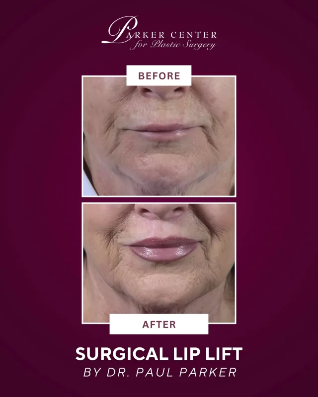 A small change can make a big difference. ✨

This 72-year-old patient wanted to rejuvenate her upper lip, which had naturally stretched over time and made her feel like she looked older than she felt.

Dr. Parker performed a lip lift, carefully removing a small “bullhorn” shaped section of skin to lift the lip into a more youthful position.

Just one week post-op, she’s already loving her refreshed, natural-looking results.

📍 Parker Center for Plastic Surgery
📩 Contact us to learn more about facial rejuvenation options.

#liplift #facialrejuvenation #plasticsurgery #naturalresults #parkercenter #beforeandafter