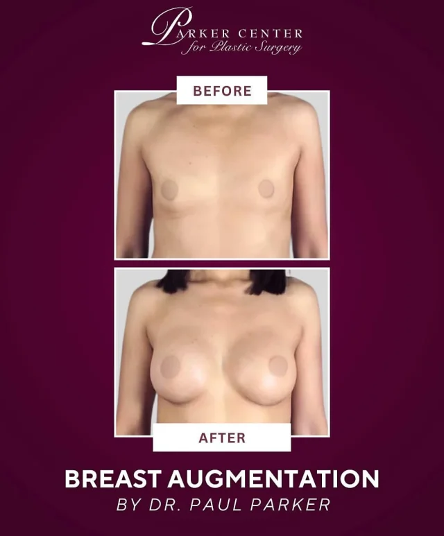 She wanted fuller, more proportionate breasts—and Dr. Parker delivered.✨

This 35-year-old patient came to us wanting to enhance her A cup to a natural-looking C cup. With 375cc silicone implants, she now feels confident, balanced, and beautifully in proportion. Smooth recovery. Minimal discomfort. Gorgeous results.

Thinking about breast augmentation? Drop your questions below or DM us to schedule a consultation with Dr. Parker.

☎️ (201) 967-1212
🗺 122 E Ridgewood Ave, Paramus, NJ 07652
📍 Parker Center for Plastic Surgery

This is an actual patient of our practice. Photos released with consent. Please do not use or distribute without permission
⁣

#paramus #paramusmall #paramusnj #bergencountynj  #breastlift plasticsurgery cosmeticsurgery breastaugmentation mommymakeover bodycontouring boobjob mastopexy breastliftwithimplants breastliftjourney breastliftsurgery breastliftresults BergenCounty BergenCountyNJ ParamusNJ EnglewoodCliffs NewJerseyPlasticSurgery NJPlasticSurgeon BergenCountyBeauty northjerseyaesthetics