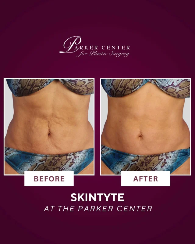 Loose skin around the abdomen is incredibly common — especially after weight loss or pregnancy.

But not everyone wants surgery to improve it. SkinTyte is a non-invasive treatment that uses advanced infrared light technology to gently heat the deeper layers of skin, stimulating collagen and helping tighten and smooth the area over time.

The result? A firmer, more refined abdominal contour without surgery and with little to no downtime.

At The Parker Center, treatments are carefully selected based on your goals and anatomy to create results that look natural and balanced.

Interested in learning if SkinTyte may be right for you?

📍 Parker Center for Plastic Surgery
📲 Call our office or send us a DM to schedule your consultation.

#skintightening #skintyte #bodysculpting #nonsurgicalskintightening #bergencountynj