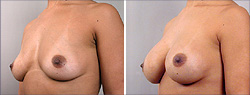 Breast Implants Before and After Images