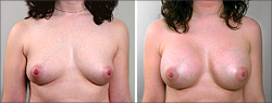 Breast Implants Before and After Images