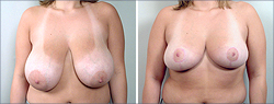Breast Reduction Before and After Images